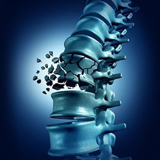 Osteoporosi: una patologia, molti specialisti